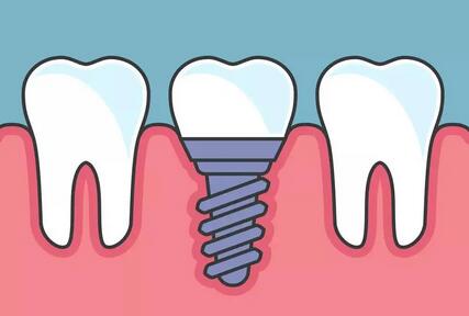 种植牙的五大危害（种植牙齿的危害有哪些）