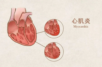 病毒性心肌炎的症状（病毒性心肌炎的症状有哪些）