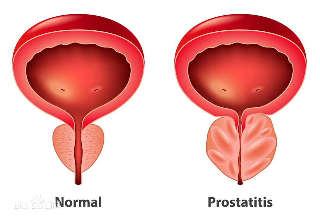 前列腺炎有什么症状和危害性 泌尿外科的常见疾病