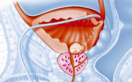 前列腺钙化灶是什么意思(前列腺钙化是什么意思)