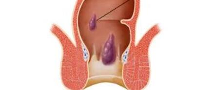 肛门口有个肉球突出是怎么回事(肛门口有个肉球突出是怎么回事有点痛)