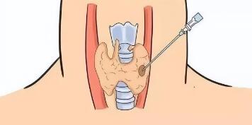 甲状腺结节4a类严重吗？需要手术吗