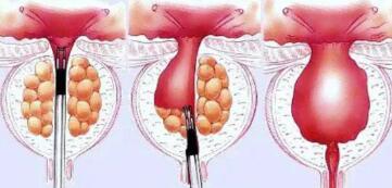 前列腺增生的最佳治疗方法(前列腺增生的最佳治疗方法吃什么药)