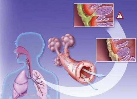 治支气管炎的药