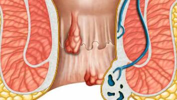 肛门口有个肉球突出是怎么回事(肛门口有个肉球突出是怎么回事怎么治疗)
