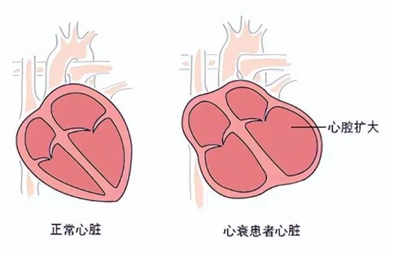 心衰的最怕三个征兆，哪些疾病容易引发心衰？