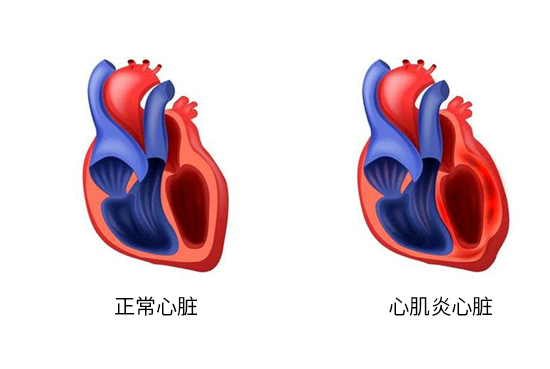 心肌酶高的孩子有什么表现，孩子心肌酶高了就一定是心肌炎？