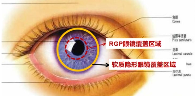 隐形眼镜多少钱，一款会呼吸的隐形眼镜